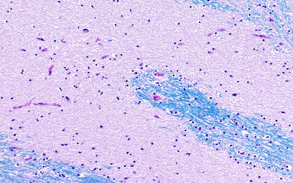 4D2 Ulegyria, 52yo, since birth (Case 4) N1 Same site LFB-PAS 1