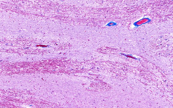 4D6 Ulegyria, 52yo, since birth (Case 4) N1 10X white matter TRI