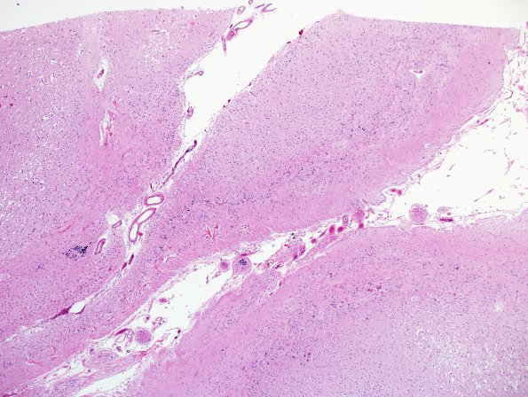 4E1 Ulegyria, 52yo, since birth (Case 4) N15 H&E 1