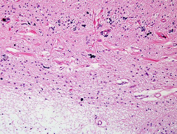 4E2 Ulegyria, 52yo, since birth (Case 4) N15 H&E 3.jpg