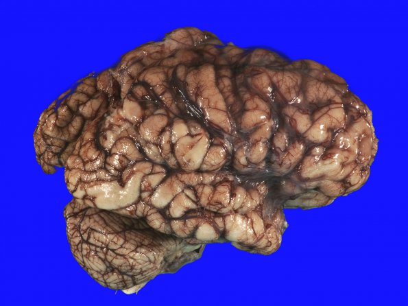 5A1 Neonatal (survived 8 years, Case 5) 2