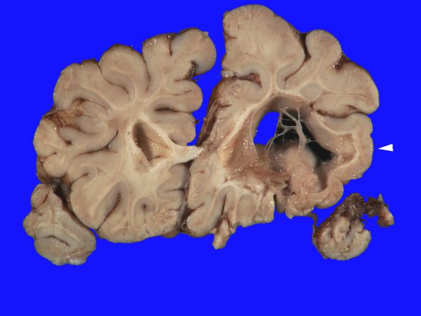 5A2 Neonatal (survived 8 years, Case 5) 3 copy