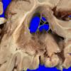 5A3 Neonatal (survived 8 years, Case 5) 5