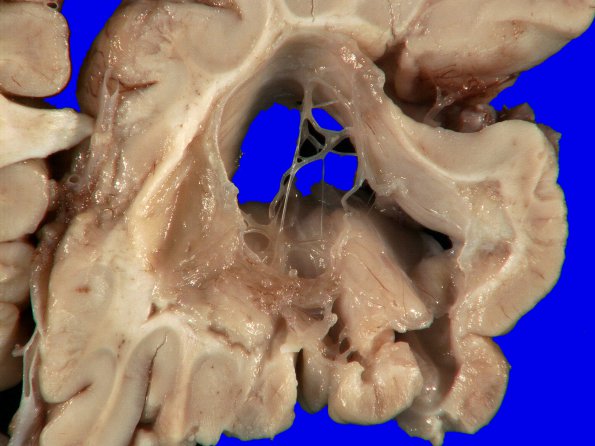 5A3 Neonatal (survived 8 years, Case 5) 5