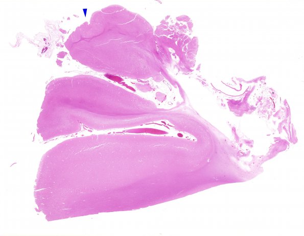 5B1 Neonatal (survived 8 years, Case 5) H&E N15 WM copy