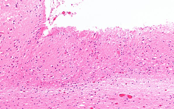 5B5 Neonatal (survived 8 years, Case 5) H&E N15 20X