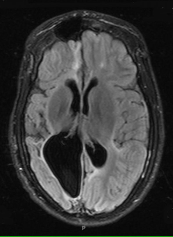 6A1 Shaken Baby - Ulegyria (Case 6) AXIAL FLAIR FS no C - Copy