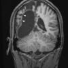 6A2 Shaken Baby - Ulegyria (Case 6) MRI 1 copy - Copy