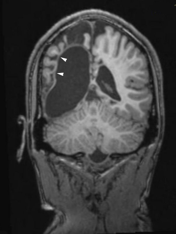 6A2 Shaken Baby - Ulegyria (Case 6) MRI 1 copy - Copy