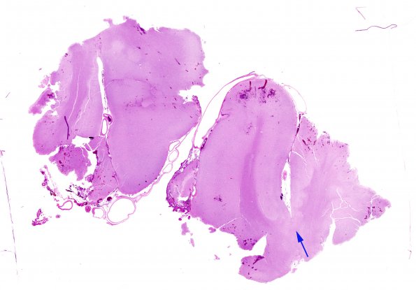 6B1 Shaken Baby - Ulegyria (Case 6) H&E 3 WM 2 copy