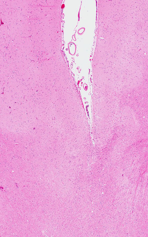 6B2 Shaken Baby - Ulegyria (Case 6) B2 4X 2