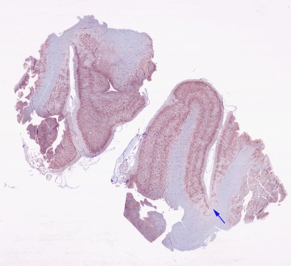 6D1 Shaken Baby - Ulegyria (Case 6) 2 NeuN WM copy