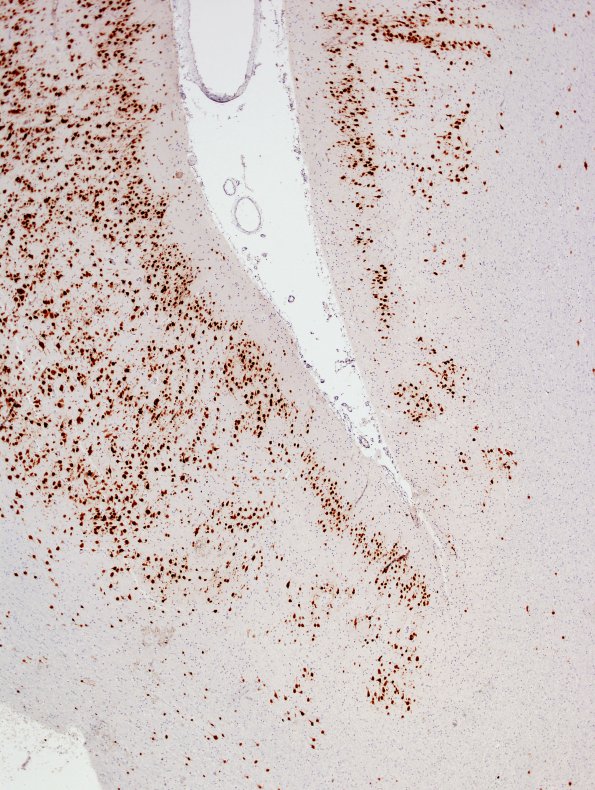 6D2 Shaken Baby - Ulegyria (Case 6) 1 NeuN 2