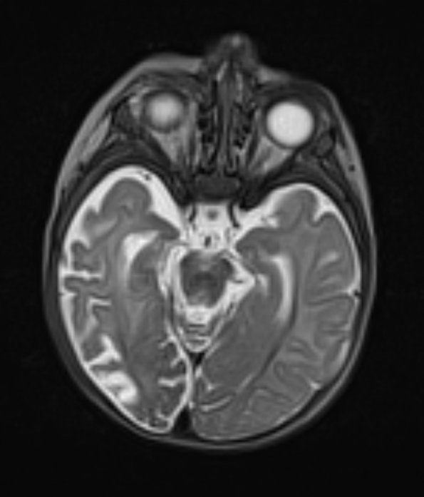 7A2 Ulegyria (Case 7) T2 with 2 - Copy