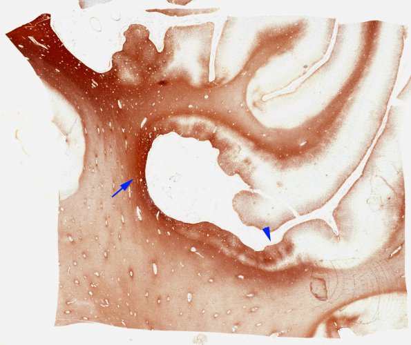 7C3 Ulegyria (Case 7) N12 GFAP A