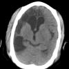 8A1 Ulegyria (Case 8) CT 1 - Copy