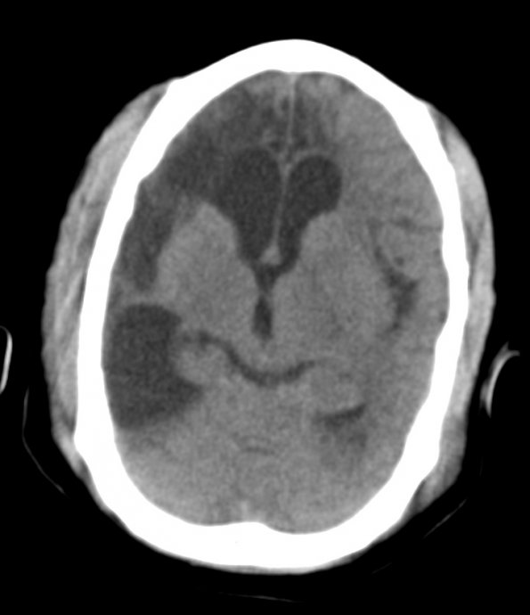 8A1 Ulegyria (Case 8) CT 1 - Copy