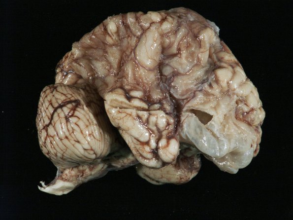 8B1 Poren-Ulegyria (Case 8) Gross_2