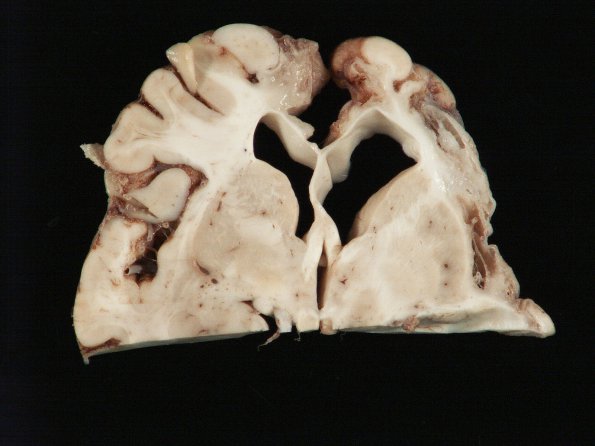 8B2 Poren-Ulegyria (Case 8) _1