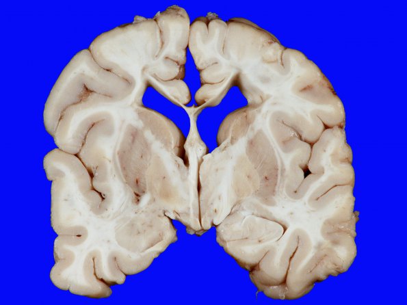 9A1 Hypoxia-Ischemia, Neonatal, (Case 9) gross_4