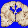 9A3 Hypoxia-Ischemia, Neonatal, (Case 9) gross_7