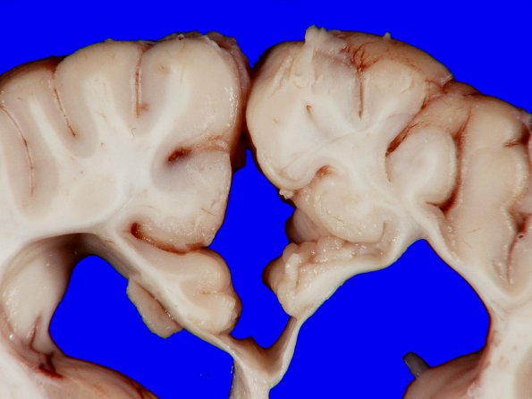 9A4 Hypoxia-Ischemia, Neonatal, (Case 9) gross_8