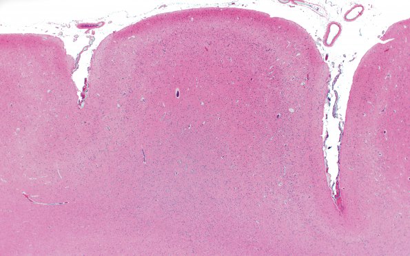 9B2 Hypoxia-Ischemia, Neonatal, (Case 9) N12 2 H&E 2X