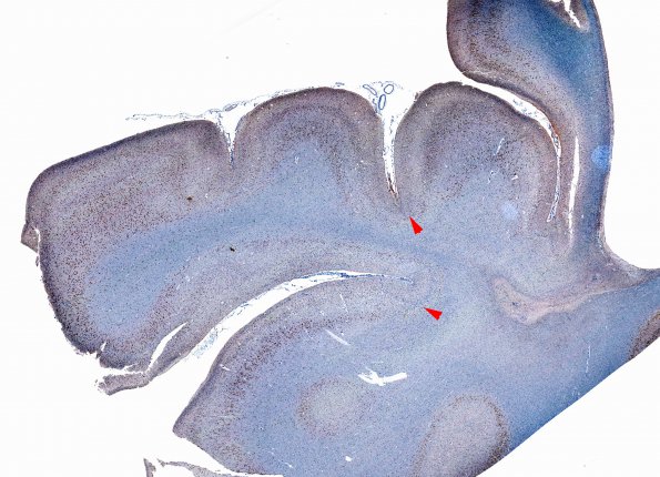 9D1 Hypoxia-Ischemia, Neonatal, (Case 9) N12 NeuN  WM copy