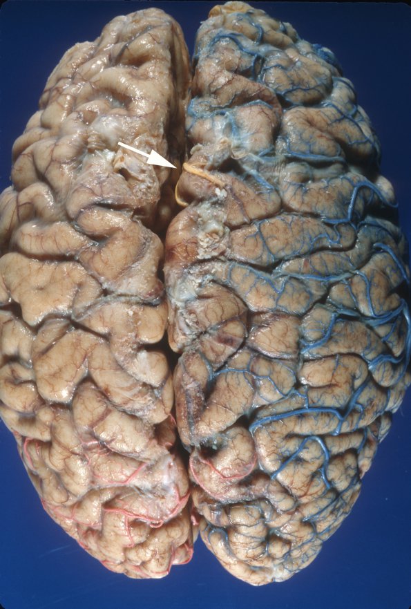 1A3 Vasculature, CNS, Normal, Injected vessels 5