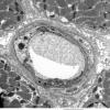 2A1 Capillary (Case 2) EM 18 - Copy