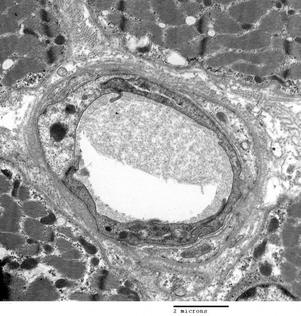 2A1 Capillary (Case 2) EM 18 - Copy