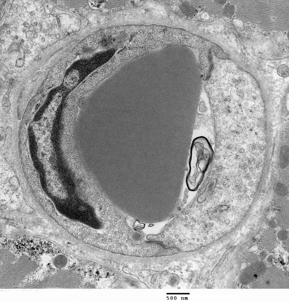 2A2 Capillary (Case 2) EM 27 - Copy