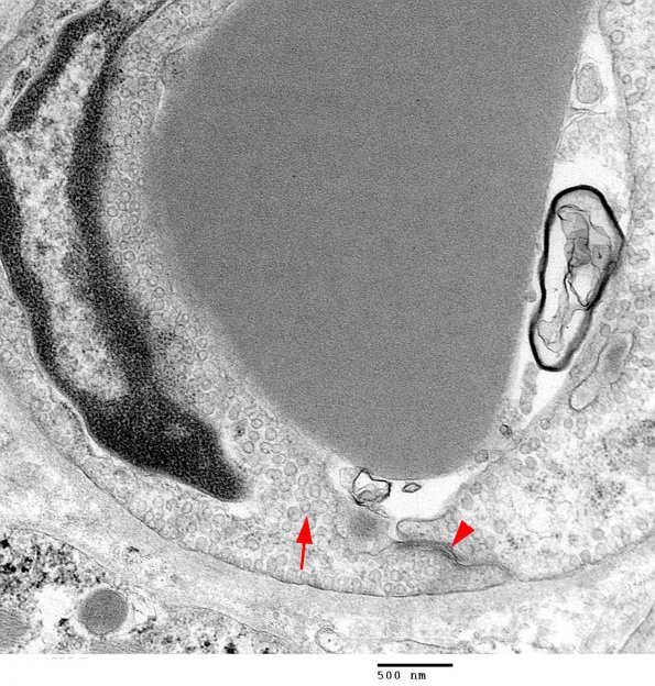 2A3 Capillary (Case 2) EM 26 - Copy copy