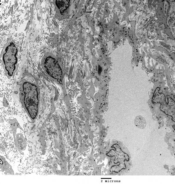 4A1 Venule Endothelium, normal, Weibel-Palade Body (Case 4) Skin_040 - Copy