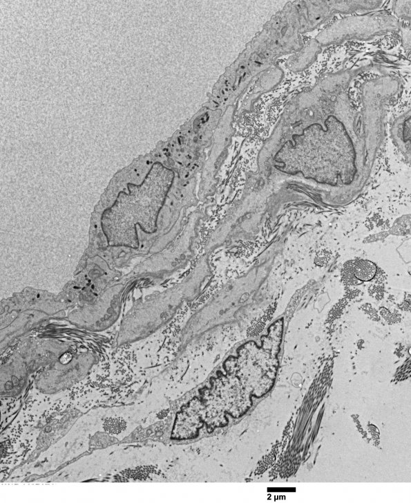 5A1 Venule Endothelium, normal (Case 5) EM 022 - Copy