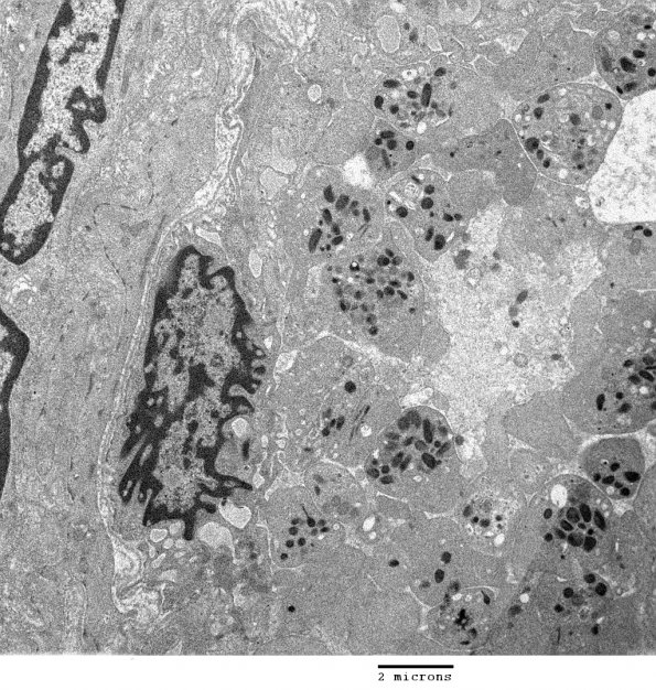 6 Platelets (Case 6) EM_007 - Copy