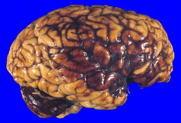 1A1 Vasculitis, GCA, aneurysm formation (Case 1)