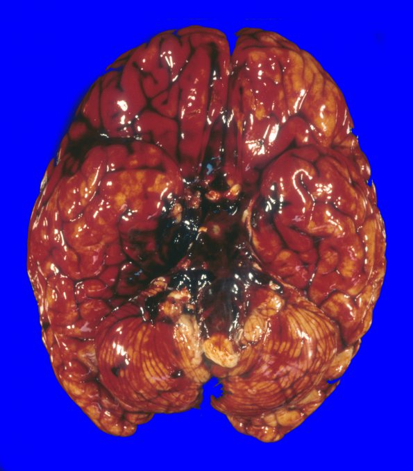 1A2 Vasculitis, GCA, aneurysm formation (Case 1) 1