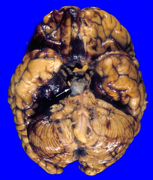 1A3 Vasculitis, GCA, aneurysm formation (Case 1) 3 copy