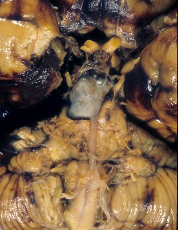 1A4 Vasculitis, GCA, aneurysm formation (Case 1)4