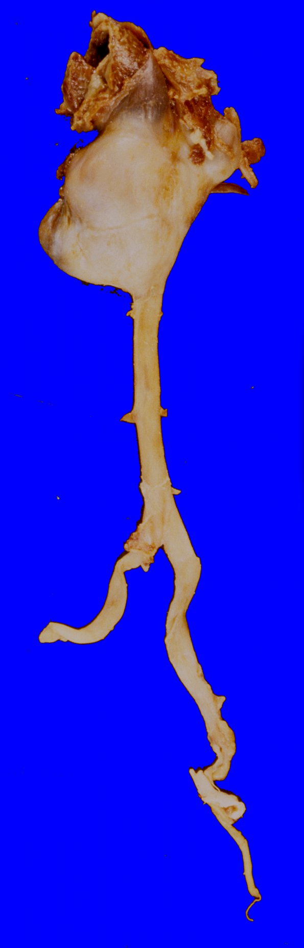 1A5 Vasculitis, GCA, aneurysm formation (Case 1)2