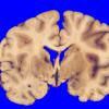 1A7 Vasculitis, GCA, aneurysm formation (Case 1)5