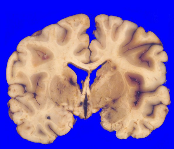 1A7 Vasculitis, GCA, aneurysm formation (Case 1)5