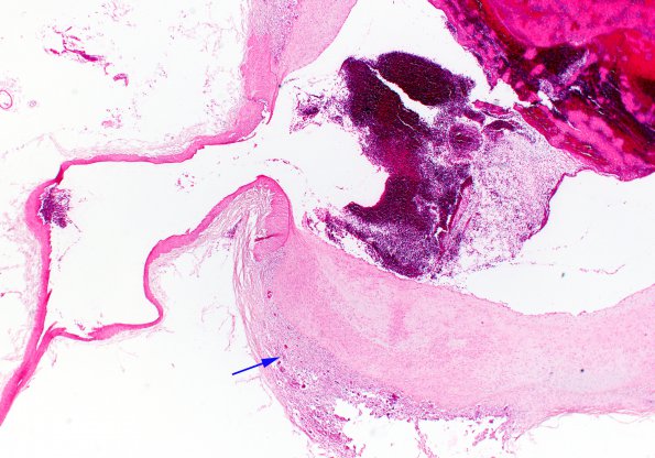 1B2 Arteritis, aneurysm, rupture (Case 1) N11 H&E 6 copy