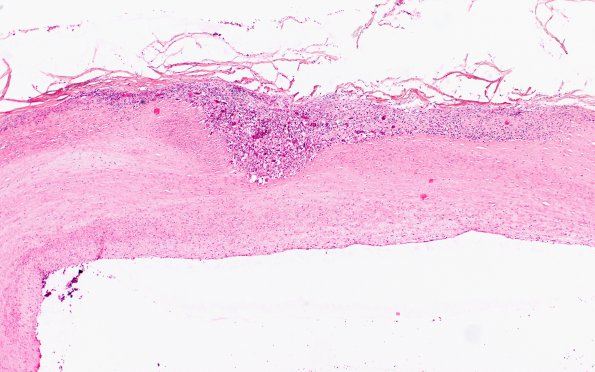 1B3 Arteritis, aneurysm, rupture (Case 1) N11 H&E 1