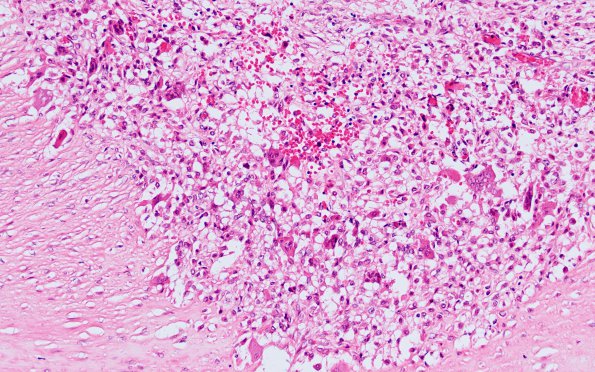 1B4 Arteritis, aneurysm, rupture (Case 1) N11 H&E 2