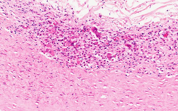 1B5 Arteritis, aneurysm, rupture (Case 1) N11 H&E 4