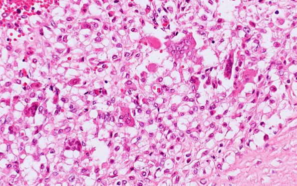 1B6 Arteritis, aneurysm, rupture (Case 1) N11 H&E 3