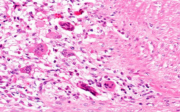 1B7 Arteritis, aneurysm, rupture (Case 1) N11 H&E 8