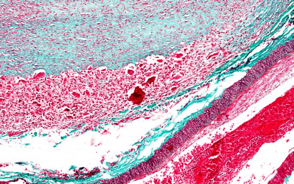 1C3 Arteritis, aneurysm, rupture (Case 1) N11 TRI 10X